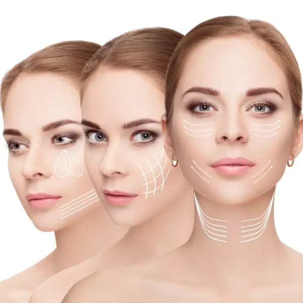 Trattamento MicroLifting